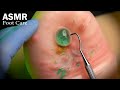 ASMR 足裏のフットケアとニキビ角栓治療のロールプレイ 足ピアス 日本語字幕 ASMR 足裏のフットケアとニキビ角栓治療のロールプレイ 足ピアス 日本語字幕