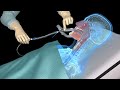 Suctioning the endotracheal tube - medical animation Mp3 Song