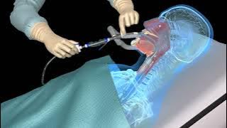 Suctioning the endotracheal tube - medical animation