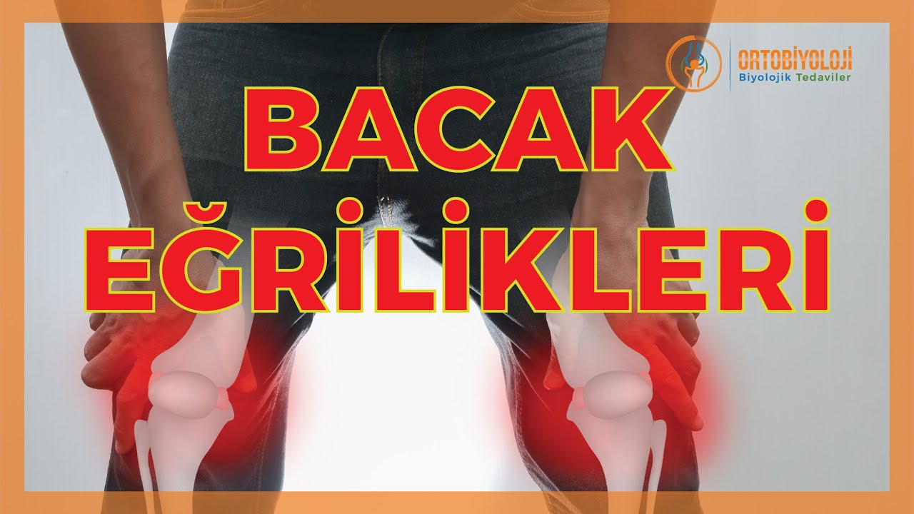 carpik bacak sorunlari ve carpik bacak tedavileri youtube