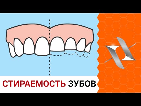 СТИРАЕМОСТЬ и СКОЛЫ ЗУБОВ | Причины. Последствия. Лечение.