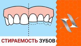 СТИРАЕМОСТЬ и СКОЛЫ ЗУБОВ | Причины. Последствия. Лечение.