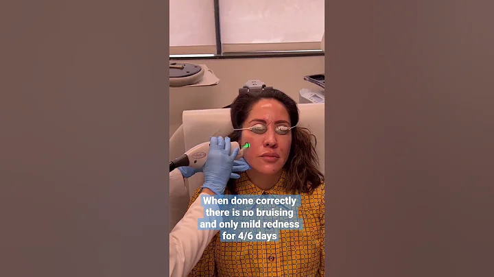 VBeam laser #shorts #vbeam #melasma