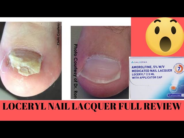 Loceryl nail lacquer buy online, side effects, price, reviews | Great Pharma