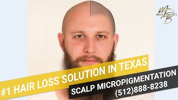Scalp Micropigmentation in Austin, TX