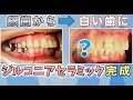 【銀歯から白い歯に】歯のアンチエイジング✨ジルコニアセラミック完成🦷