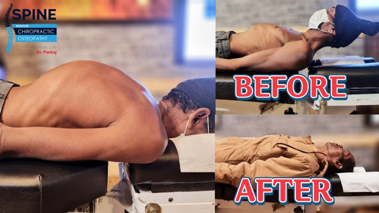 best chiropractic in india # hyderabad # bangalore #kyphosis & Scoliosis treatment | bent spine