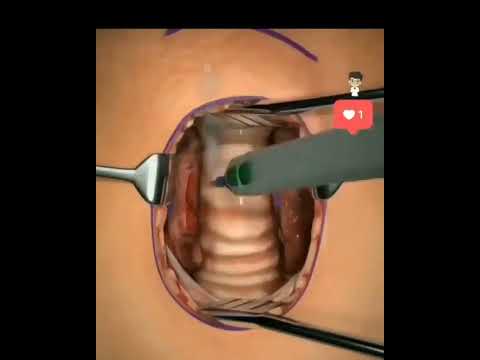 فيديو: كيف يتم إجراء بضع الصدر؟