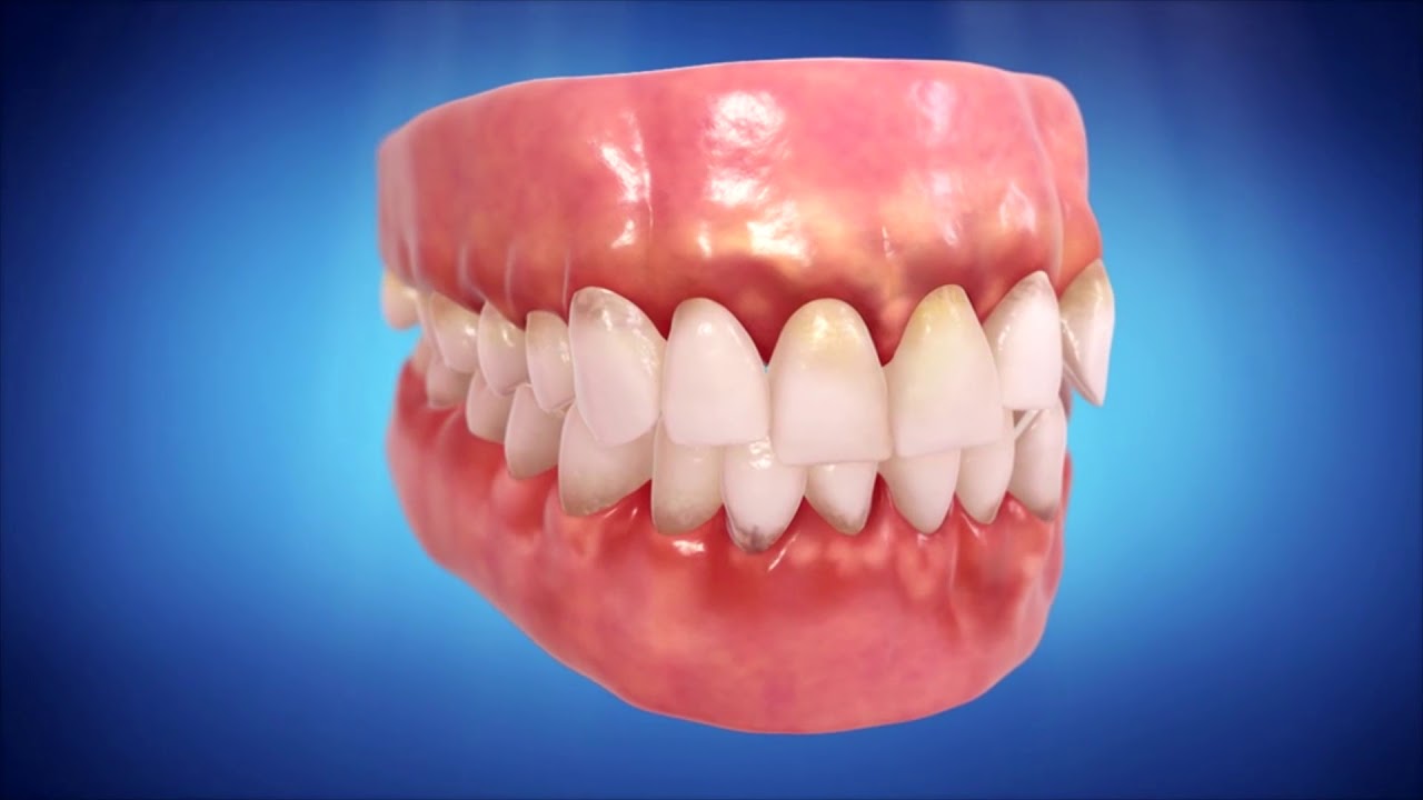 How Crooked Teeth Affect Oral Health YouTube