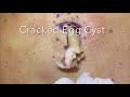 Cracked Egg Cyst. Large deep cyst popped and removed on back. Tracks down to deep pocket. MrPopZit.