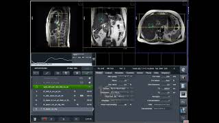 How to Plan Coronal MRI Sequences on Siemens 1.5T & 3T | Full Tutorial