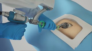 SSM Health Medical Minute: Robotic-assisted knee and hip replacement offered in St. Louis
