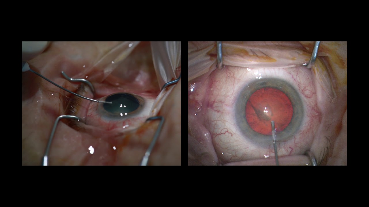 Katarakt Operation - Prof. 