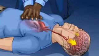 YouTube - Continuous Chest Compression CPR - Mayo Clinic.flv