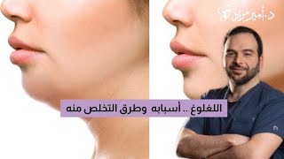 اللغلوغ أسبابه وطرق التخلص منه -دكتور أمير مراد استشاري جراحة التجميل دكتور_أمير_مراد-صباح السعودية