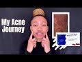 Is Oratane/Accutane the cure to Acne? The side effects and My Acne Journey .