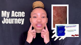 Is Oratane/Accutane the cure to Acne? The side effects and My Acne Journey .