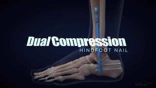DualCompression Hindfoot Fusion Nail Demonstration