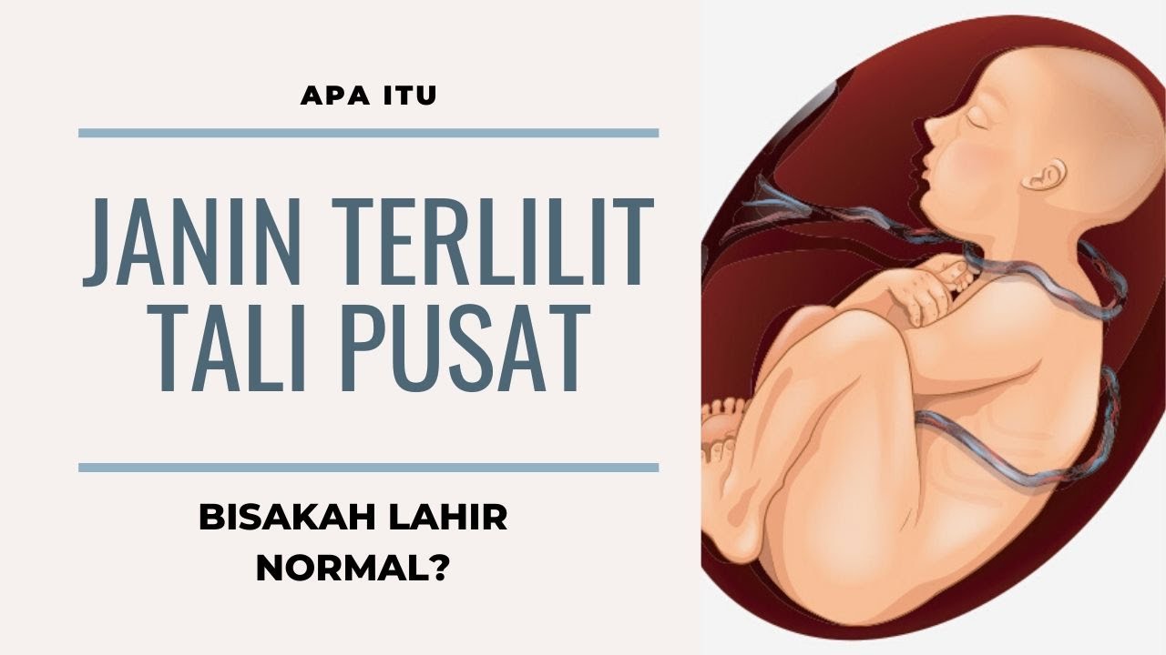 Bahaya, Penyebab dan Cara Mengatasi Lilitan Tali Pusat