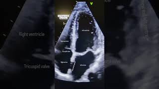 Standard 4-Chamber View Echocardiography, A Window to the Heart.