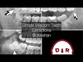 Erupted wisdom teeth extractions step by step drwahan