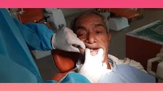 MULTISTEP/ SECTIONAL BORDER MOULDING AND FINAL IMPRESSION IN COMPLETE DENTURE PROSTHODONTICS