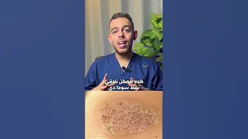 الفرق بين عين السمكة ومسمار القدم واسبابهم وعلاجهم طب اكسبلور Shorts 