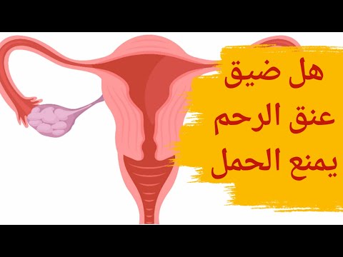 هل ضيق عنق الرحم يمنع الحمل