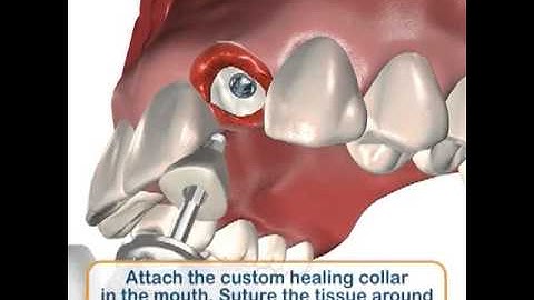 Legacy™3 Narrow Diameter Custom Healing Collar