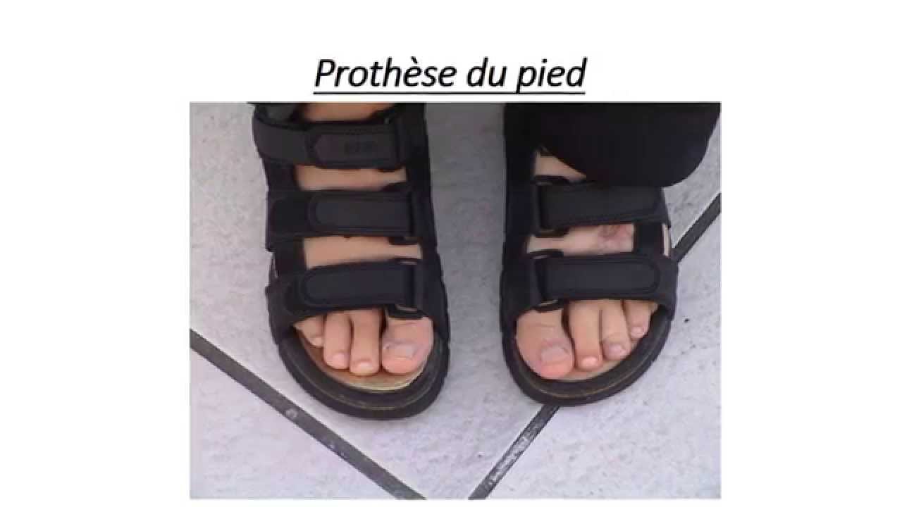 Prothese pied / Foot Prosthesis / Feet Prosthesis - YouTube