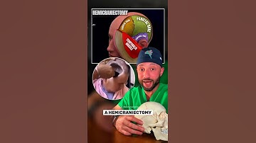 Removing a￼ portion of the skull can be life saving. #medical #doctor