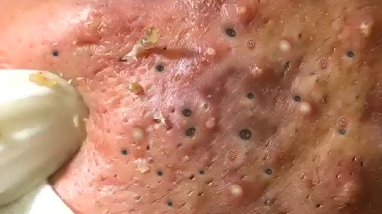Blackhead Extractions | Blackheads Removal | Acne Treatment | Big