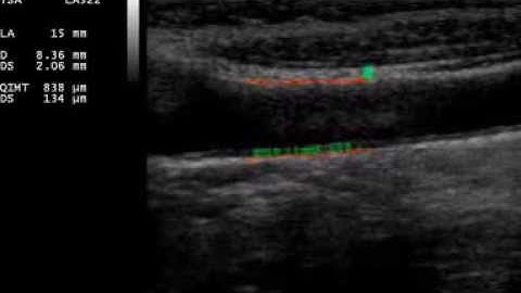 IMT AUTOMATED MEASURE: RADIOFREQUENCY SIGNALS