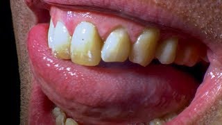 What Happens When You Don't Brush Your Teeth? | Earth Lab