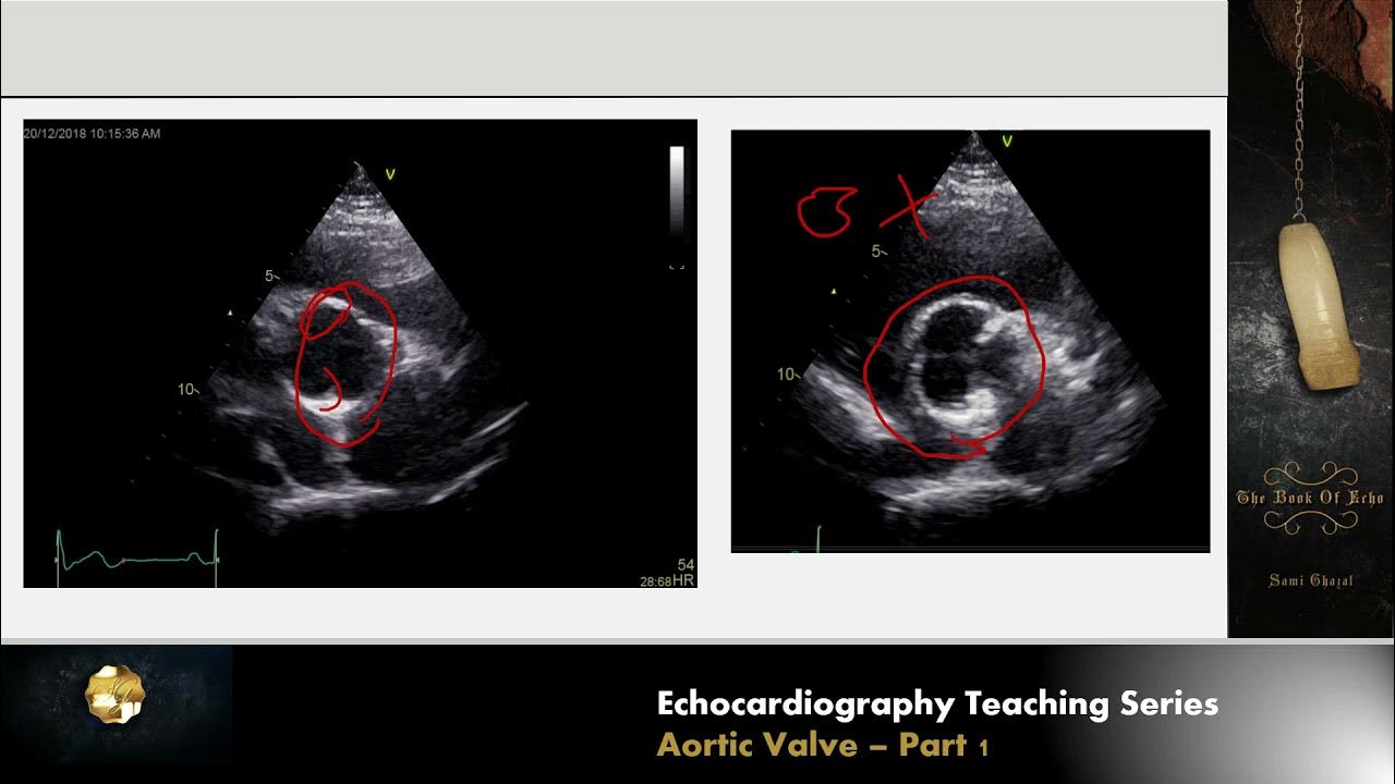 Lecture 9 Aortic Valve Part 1 YouTube