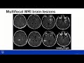 Antibody Prevalence in Epilepsy and Encephalopathy (APE2) Score