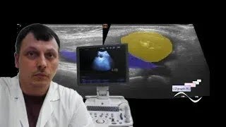 Pediatric MSK ultrasound - Fluid above the knee screenshot 5