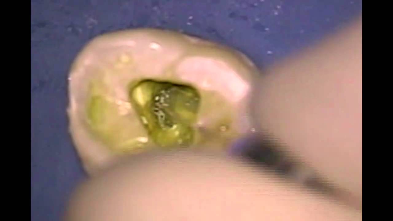 Access and Instrumentation of Calcified Molar YouTube