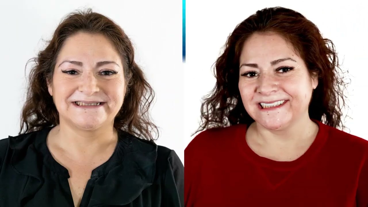 Dental Implants: A Patient's Experience | Smile Makeover