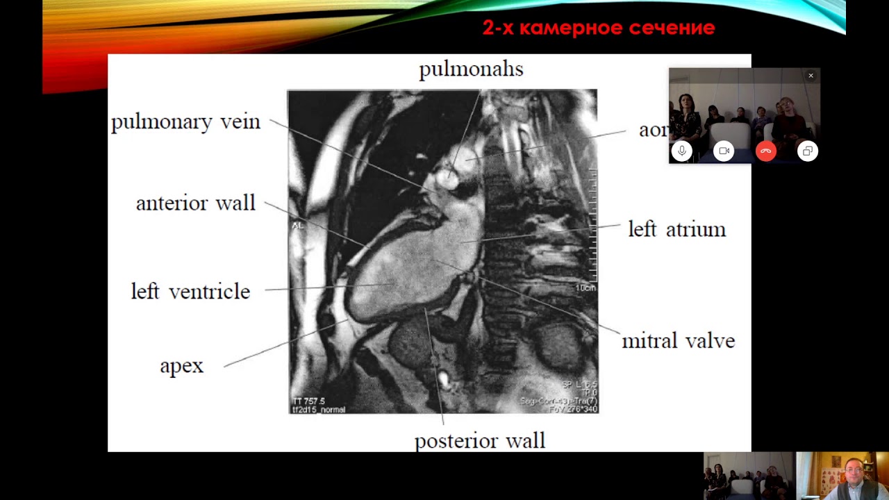 Лекция "Исследование МРТ Сердца в практике кардиолога". Лектор: Малов А.А.