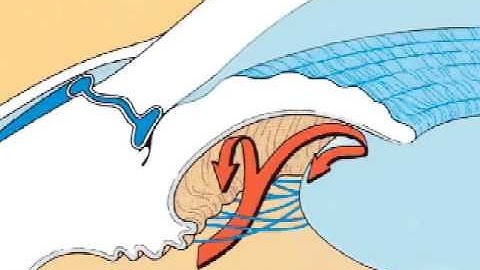 Description of Angle-Closure Glaucoma