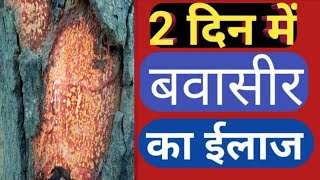 2 दिन में 20 साल पुरानी बबासीर ठीक हो गई //piles ka ilaj || babasir ka ilaj //