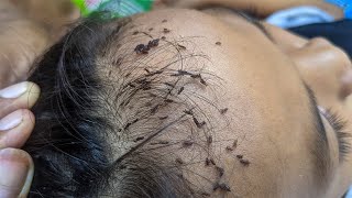 Remove a lot of short hair - Getting out all of big lice