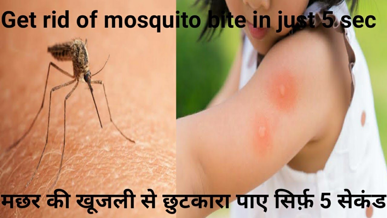मछर की खुजली से छुटकारा पाए वो भी सिर्फ 5 सेकंड में।Get rid of mosquito bite in just 5 sec