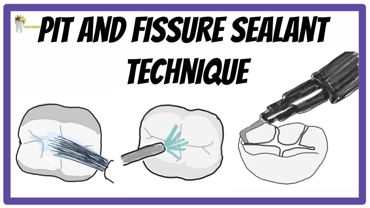 PIT AND FISSURE SEALANTS Indications Contraindications TECHNIQUE 