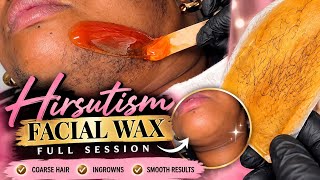 From 👉🏾COARSE to CLEAN ✨ | Facial Wax Transformation #Hirsutism