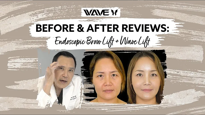 Before and After: Endoscopic Brow lift with a Mini Facelift (Wavelift) | Wave Plastic Surgery