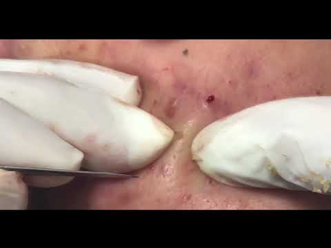  MINUTES OF EXTRACTING ACNE!