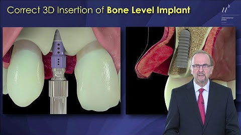 290-00 Early Implant Placement Post Extraction with Simultaneous Contour Augmentation PREVIEW