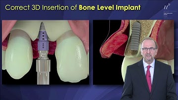 290-00 Early Implant Placement Post Extraction with Simultaneous Contour Augmentation PREVIEW